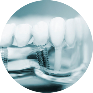 dental-implants-panel